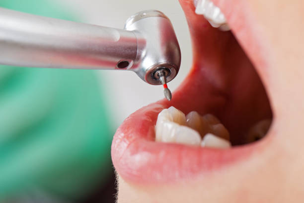 Best Broken or Chipped Tooth Repair in Selma, AL